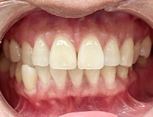 Patient image before invisalign procedure