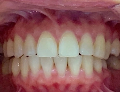 Patient image after invisalign procedure