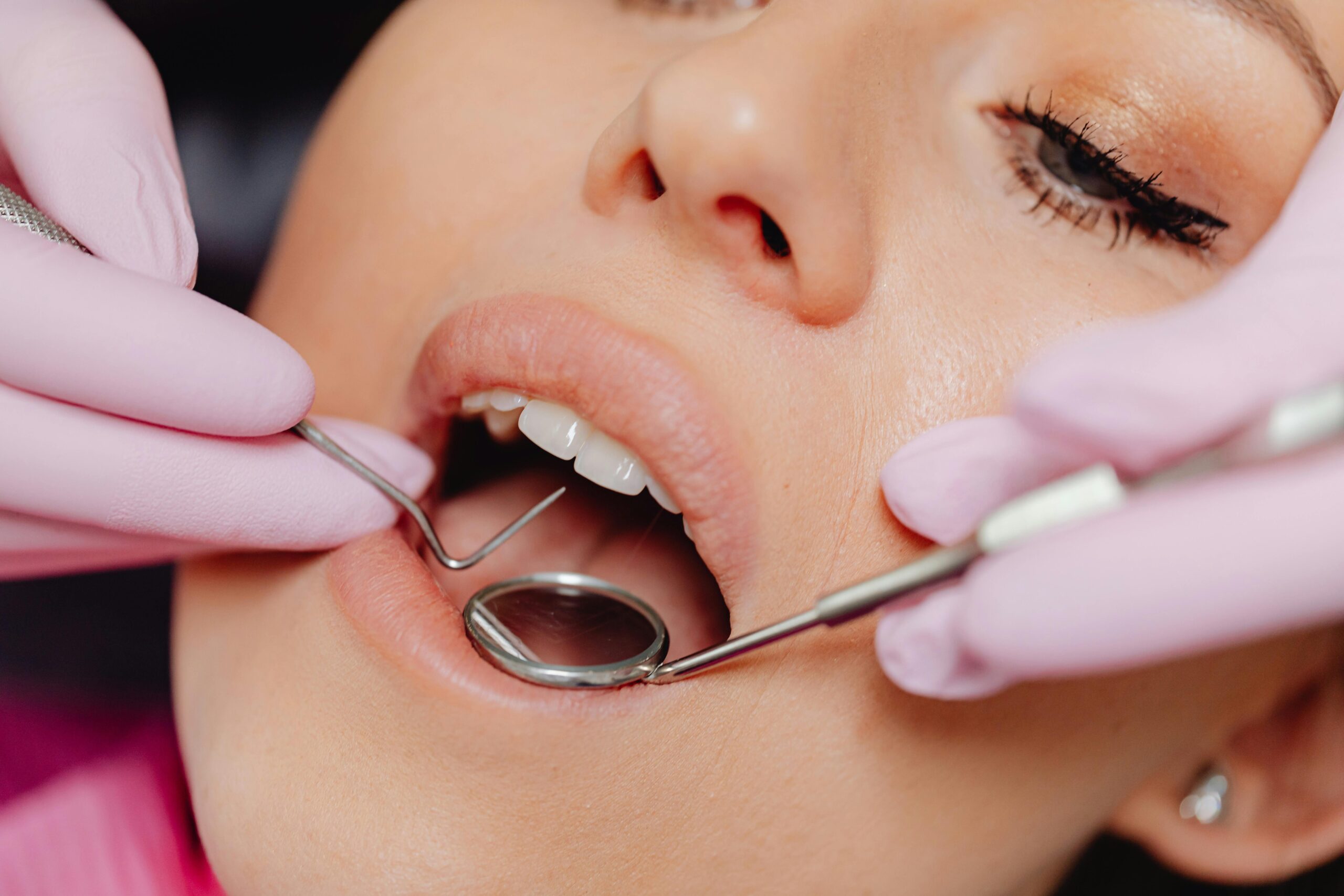 patient getting teeth checked by a dentist before teeth cleaning and getting a dental filling